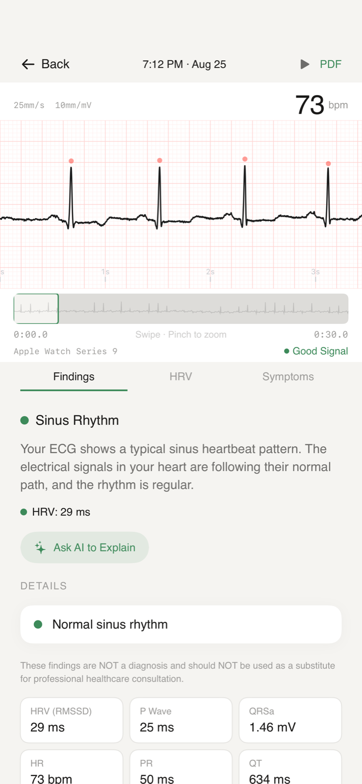 ECG Lab showing an Apple Watch ECG strip with a Sinus Rhythm finding explained in plain English